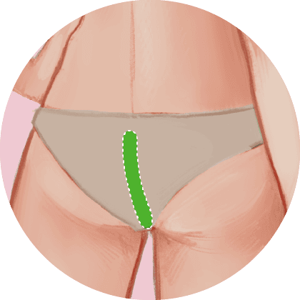 Perianal (Avulso)